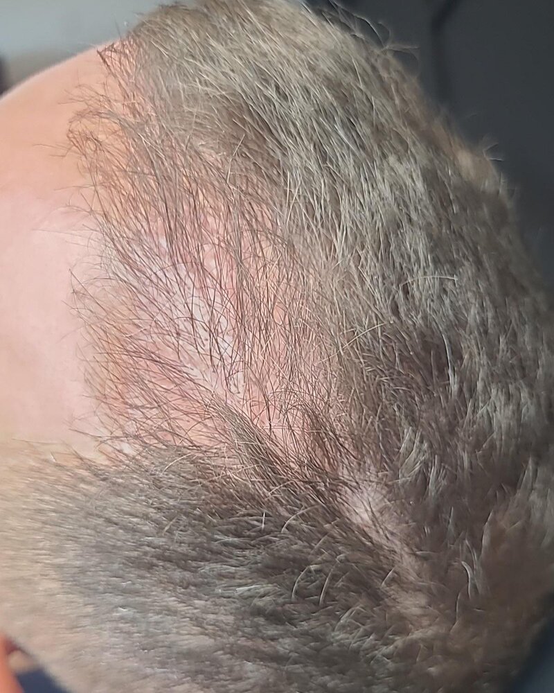 After: PRP hair restoration, real client results at Rejuven8