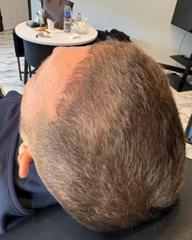 Before: PRP hair restoration, real client results at Rejuven8